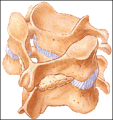 posterior cervical fusion