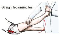 straight leg test