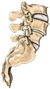 type3 spondy 1