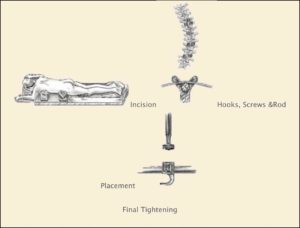 Posterior Approach Houston, TX | Modern Spine